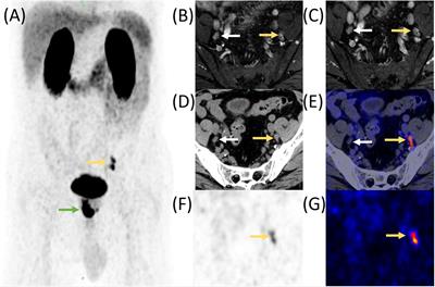 Current status of PSMA-targeted imaging and therapy